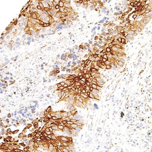 TAG-72-IHC072-Lung