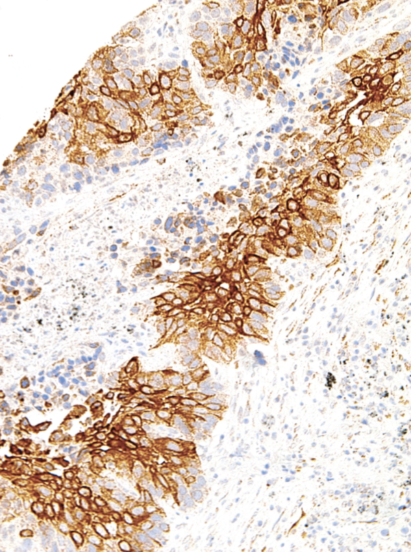 TAG-72-IHC072-Lung