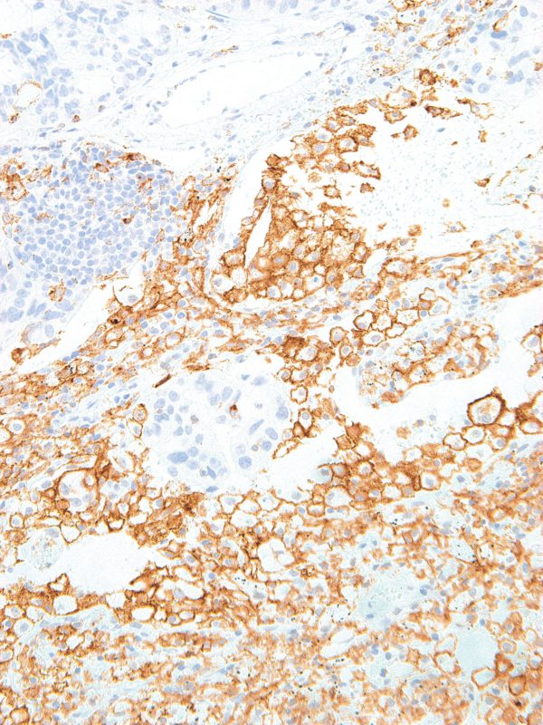 TIM3-IHC003-Lung