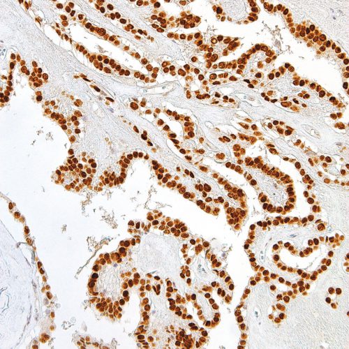 TTF-1-IHC414-Thyroid