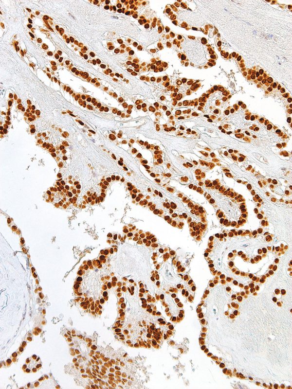 TTF-1-IHC414-Thyroid