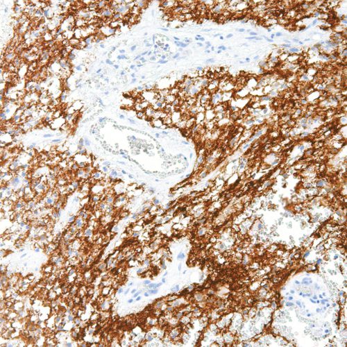 Tau-IHC696-Brain-Cancer