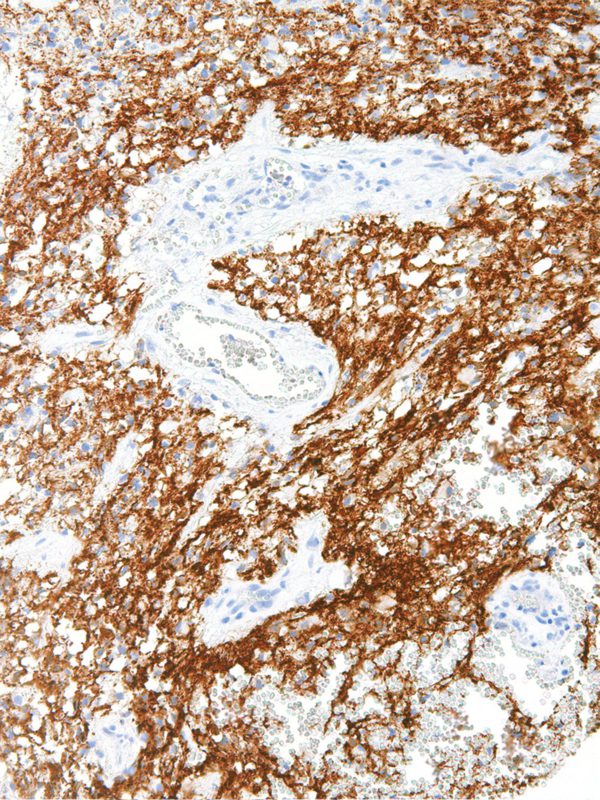 Tau-IHC696-Brain-Cancer