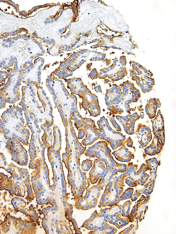 Thyroglobulin-IHC674-Thyroid