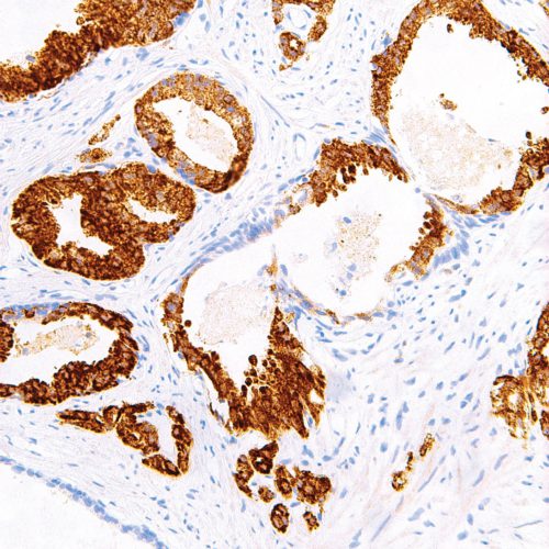 p504s-IHC504-Prostate