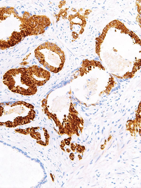 p504s-IHC504-Prostate