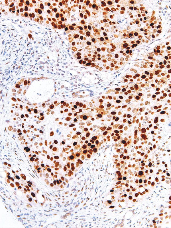 p53-IHC053-Lung