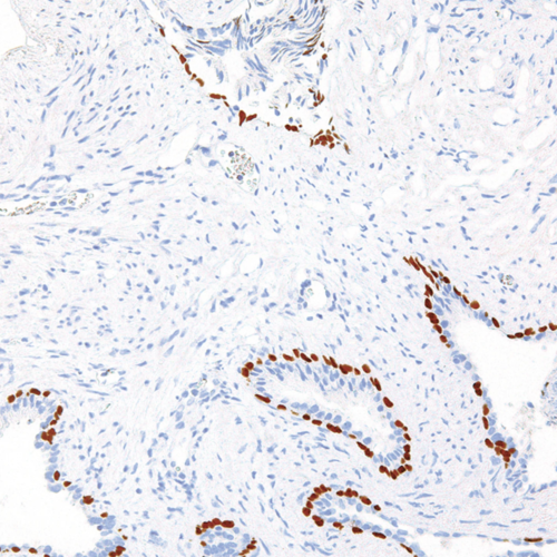 p63-IHC063-Prostate-Cancer