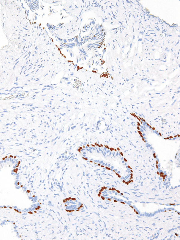 p63-IHC063-Prostate-Cancer