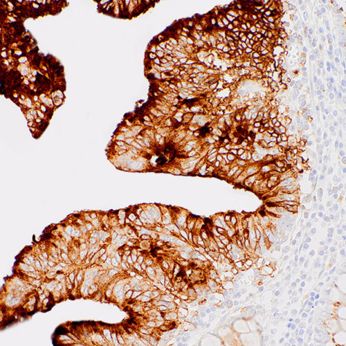 CA19-9-IHC199-Colon-Cancer