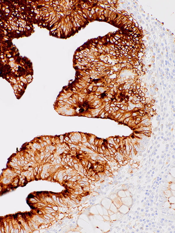 CA19-9-IHC199-Colon-Cancer