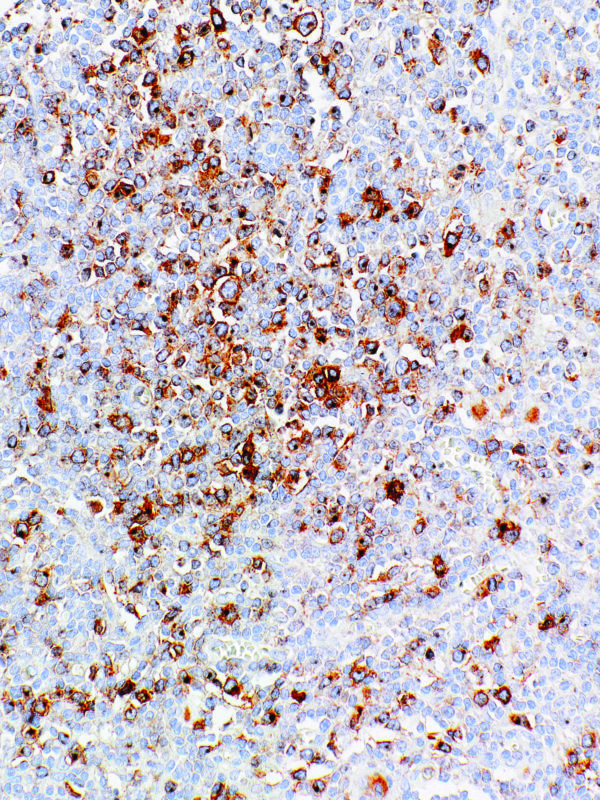 CD30-IHC130-Hodgkin Lymphoma (Mouse)