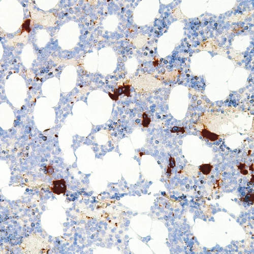 CD61-IHC061-Bone-Marrow