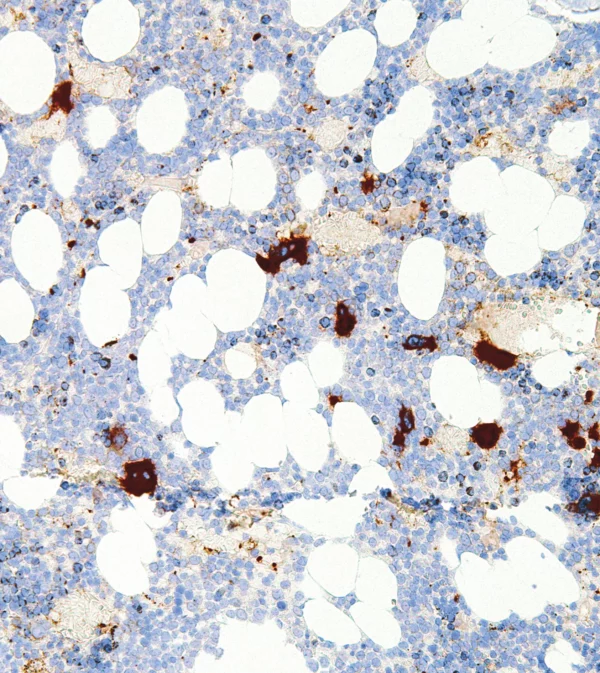 CD61-IHC061-Bone-Marrow