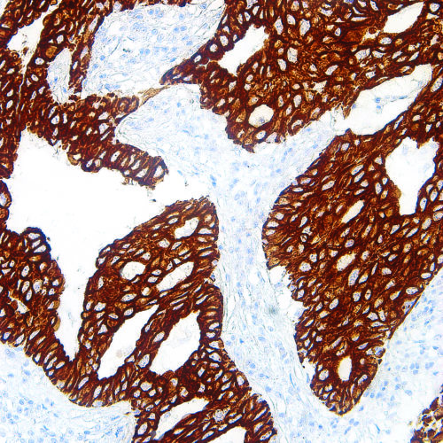 Cytokeratin-7-IHC007-Lung-Adenocarcinoma