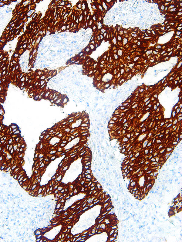 Cytokeratin-7-IHC007-Lung-Adenocarcinoma