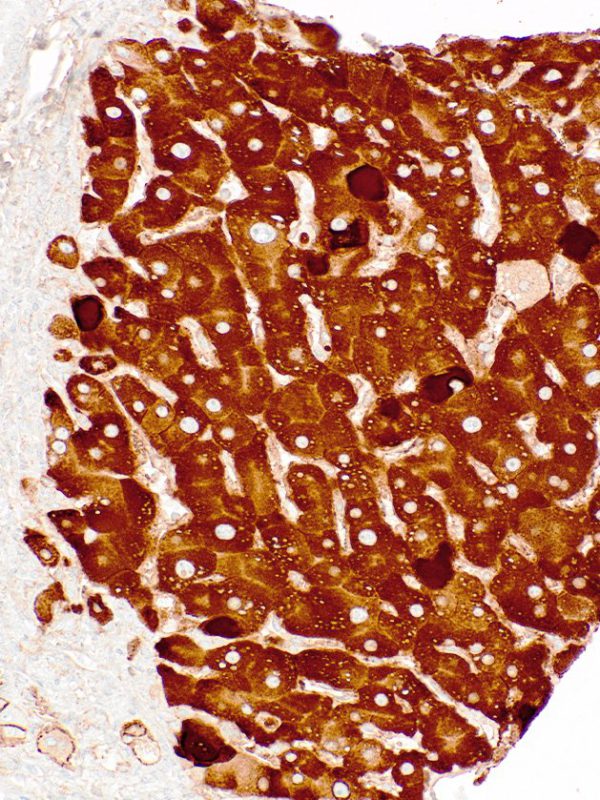 HBsAg-IHC178-Liver