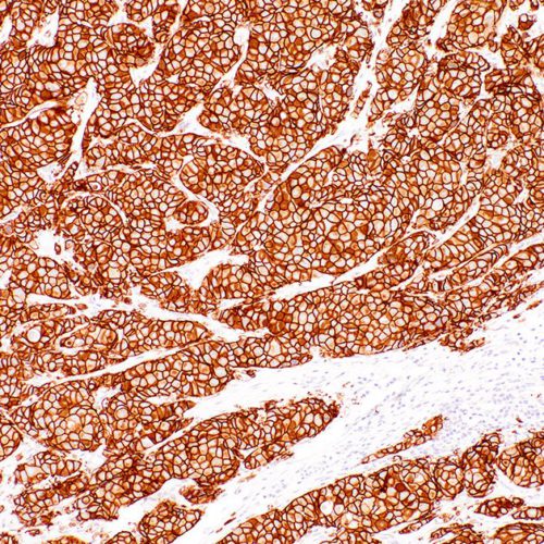 HER2-IHC042-Breast