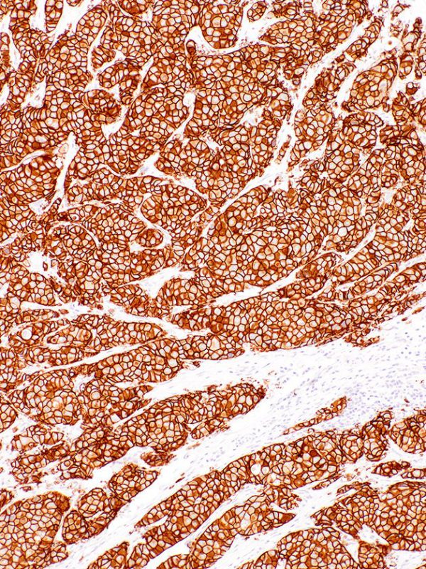 HER2-IHC042-Breast