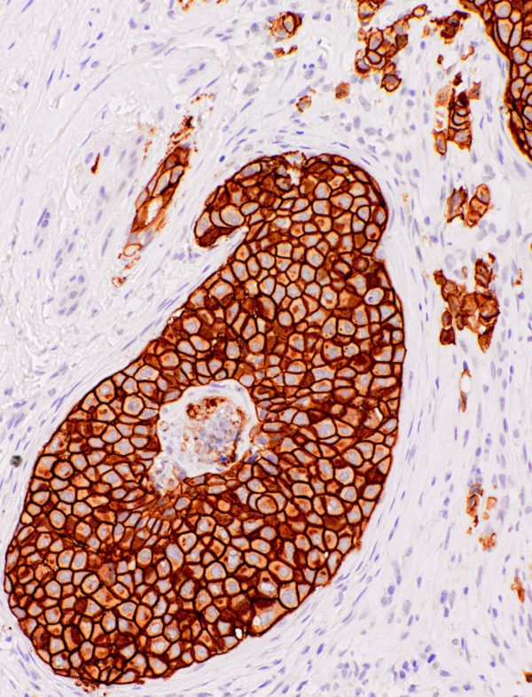 Her2-IHC012-Breast (Rabbit)