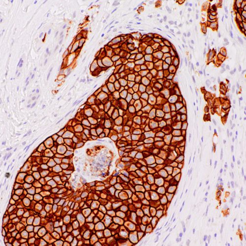 Her2-IHC012-Breast (Rabbit)