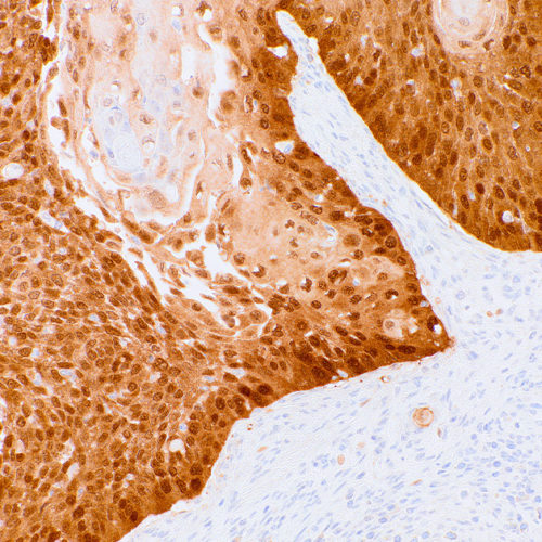 P16-IHC216-Cervical-Cancer