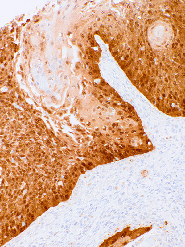 P16-IHC216-Cervical-Cancer