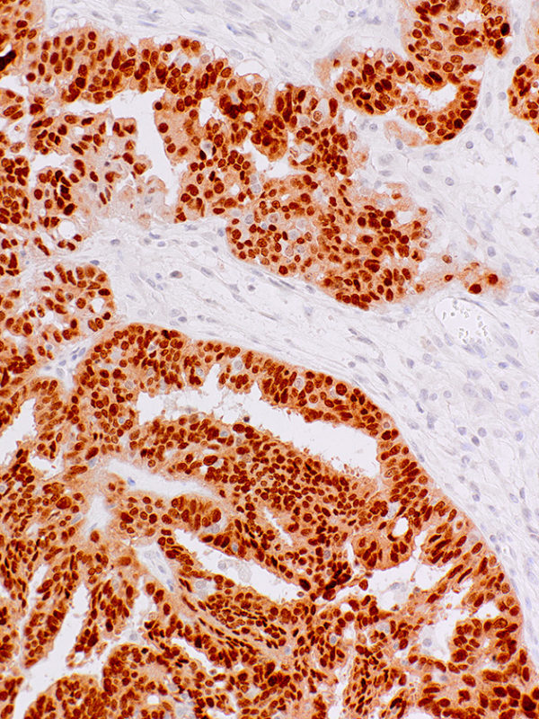 PAX9-IHC008-Ovary