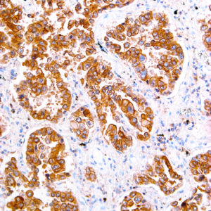 ROS1-IHC041-Lung-Cancer