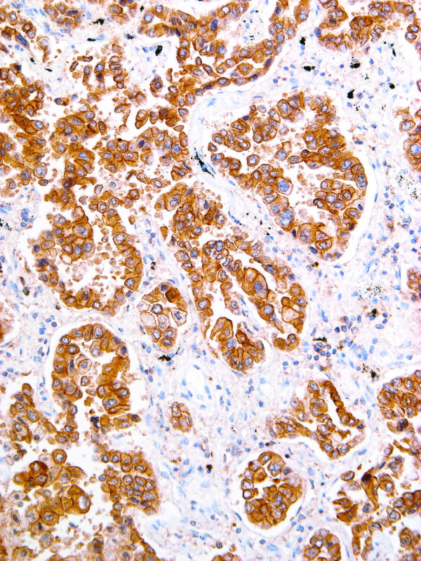 ROS1-IHC041-Lung-Cancer