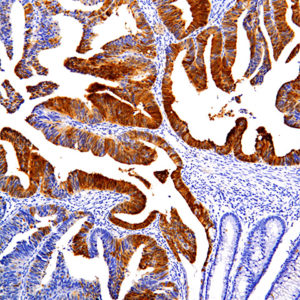 p16-INK4A-IHC016-Colon-Cancer