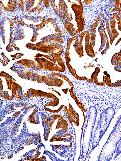 p16-INK4A-IHC016-Colon-Cancer