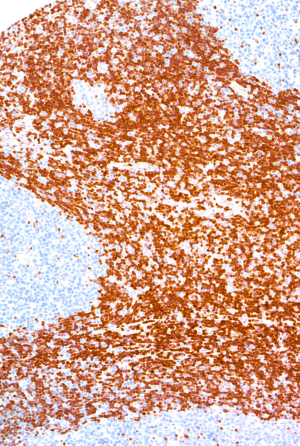 p27-IHC027-Lymph-Node